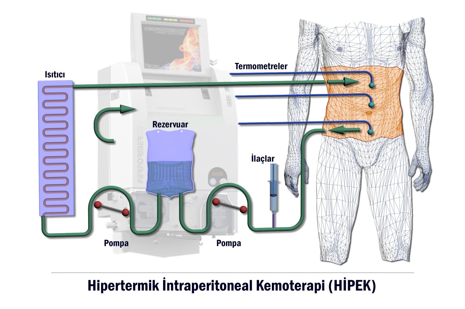 Sıcak Kemoterapi HİPEC Nedir Nasıl Uygulanır