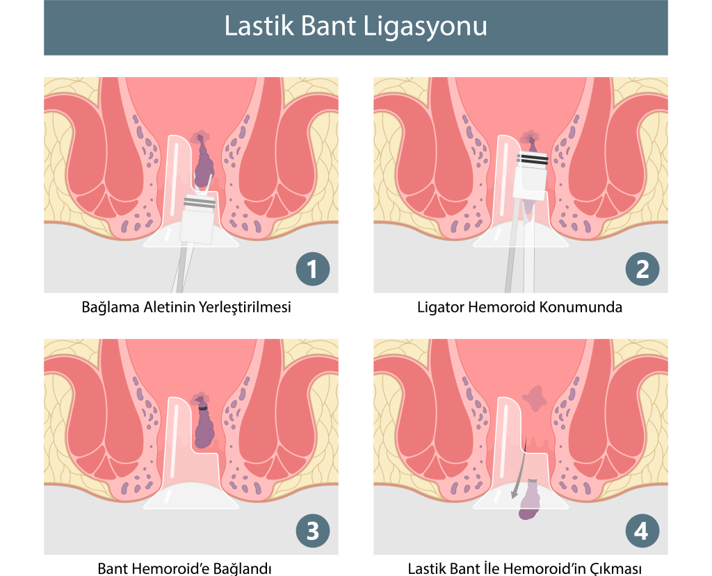 Lastik Bant Ligasyonu