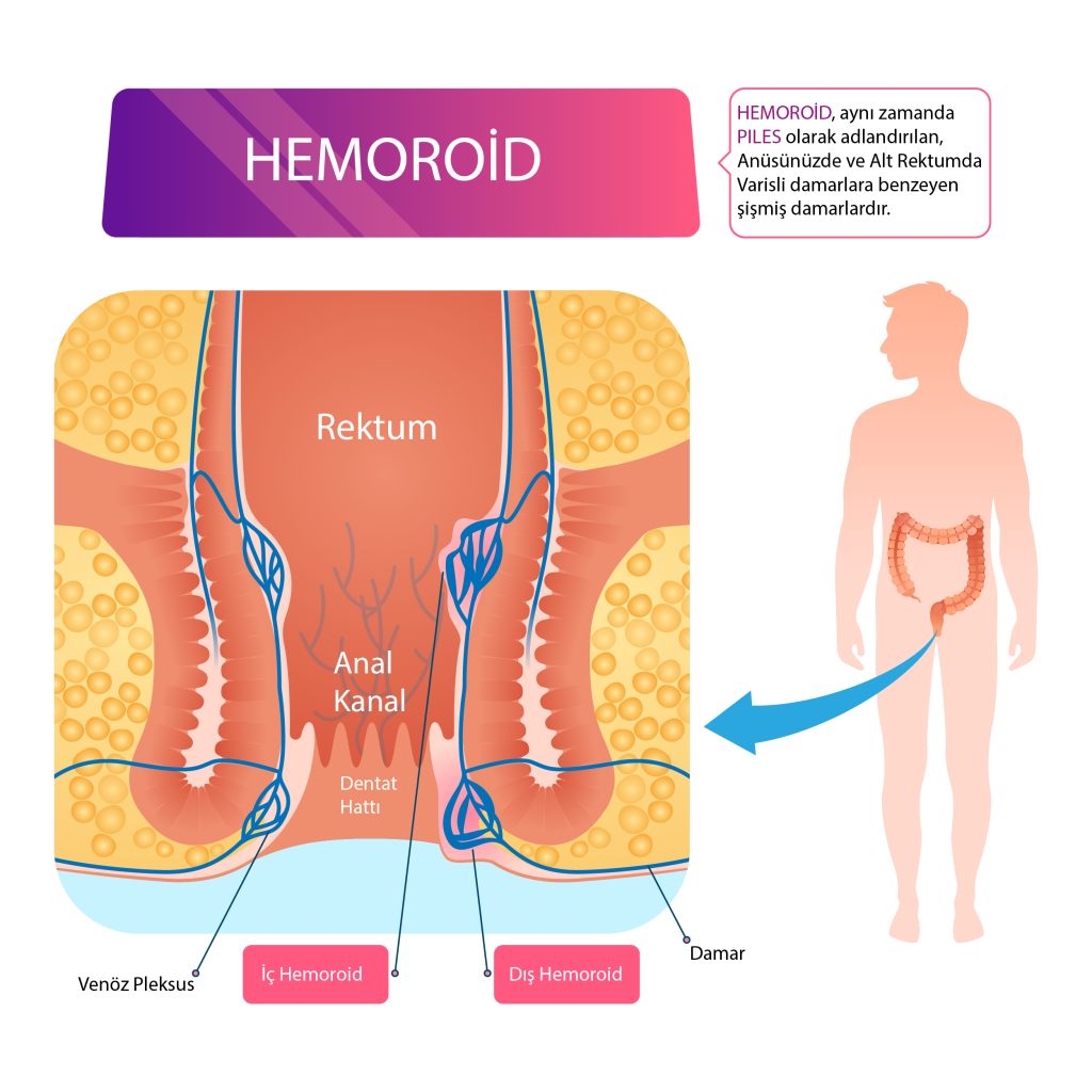 Hemoroid nedir