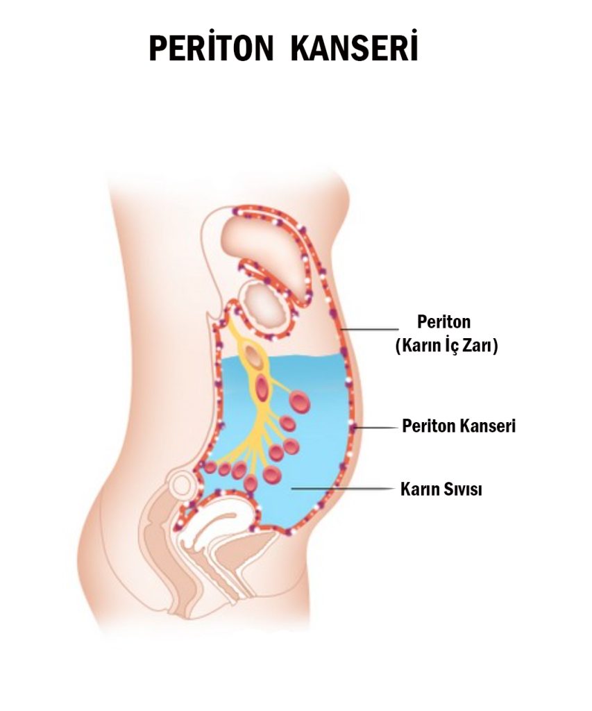 Peritoneal Karsinomatozis (Karın Zarı Kanseri)