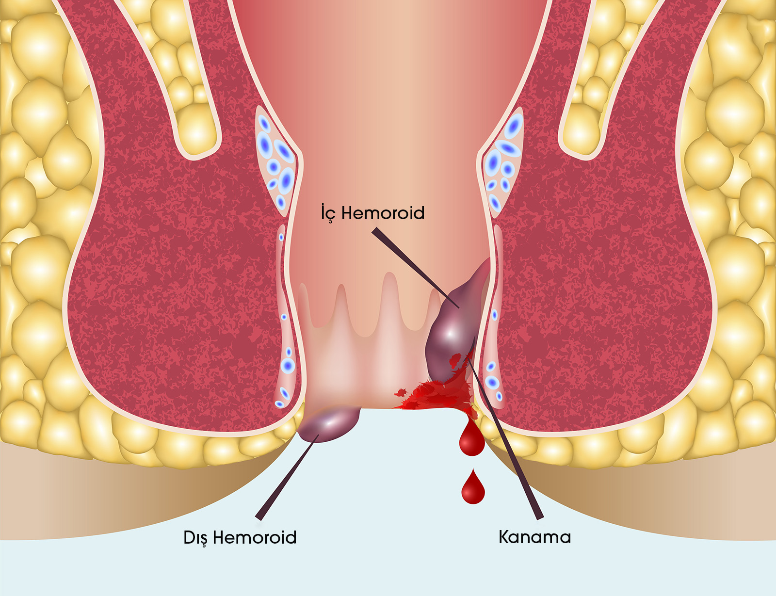 Геморрой влияет на потенцию. Внешний наружный геморрой. Воспаление наружных геморроидальных узлов.