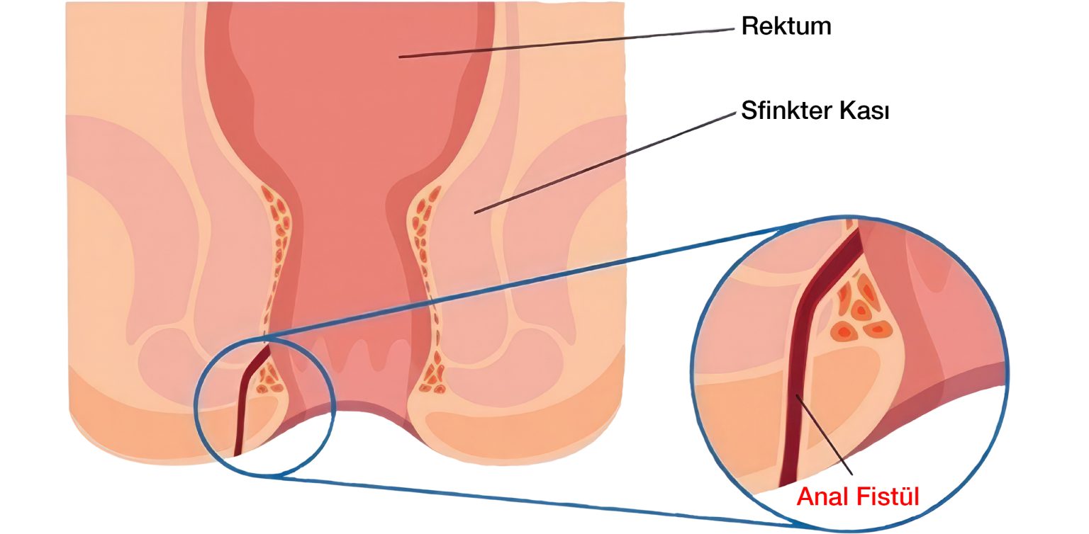 Anal Fist l Nedir Belirtileri Nelerdir Tedavisi Zor Mu anal-fist-l-nedir-belirtileri-nelerdir-tedavisi-zor-mu