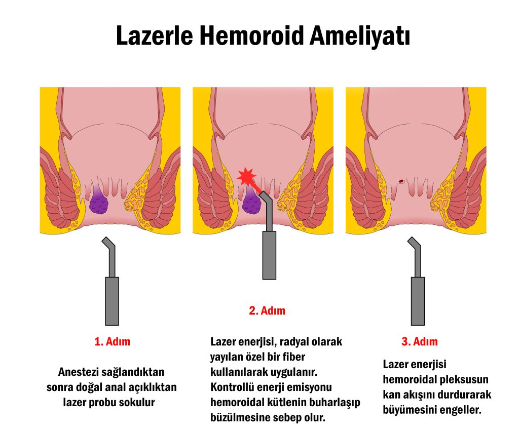 Lazerle Hemoroid Ameliyati
