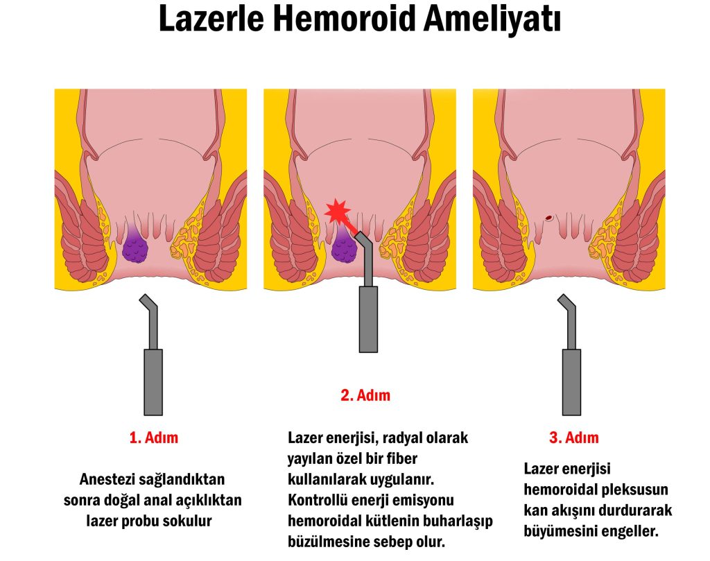 Lazerle Hemoroid Ameliyatı Nasıl Yapılır