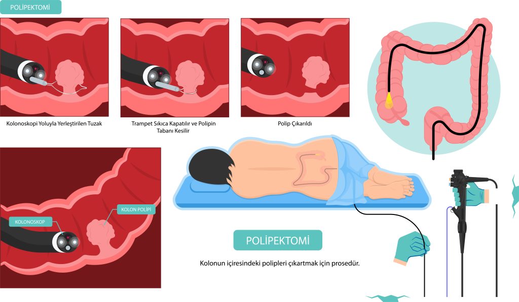 Polipektomi Nedir