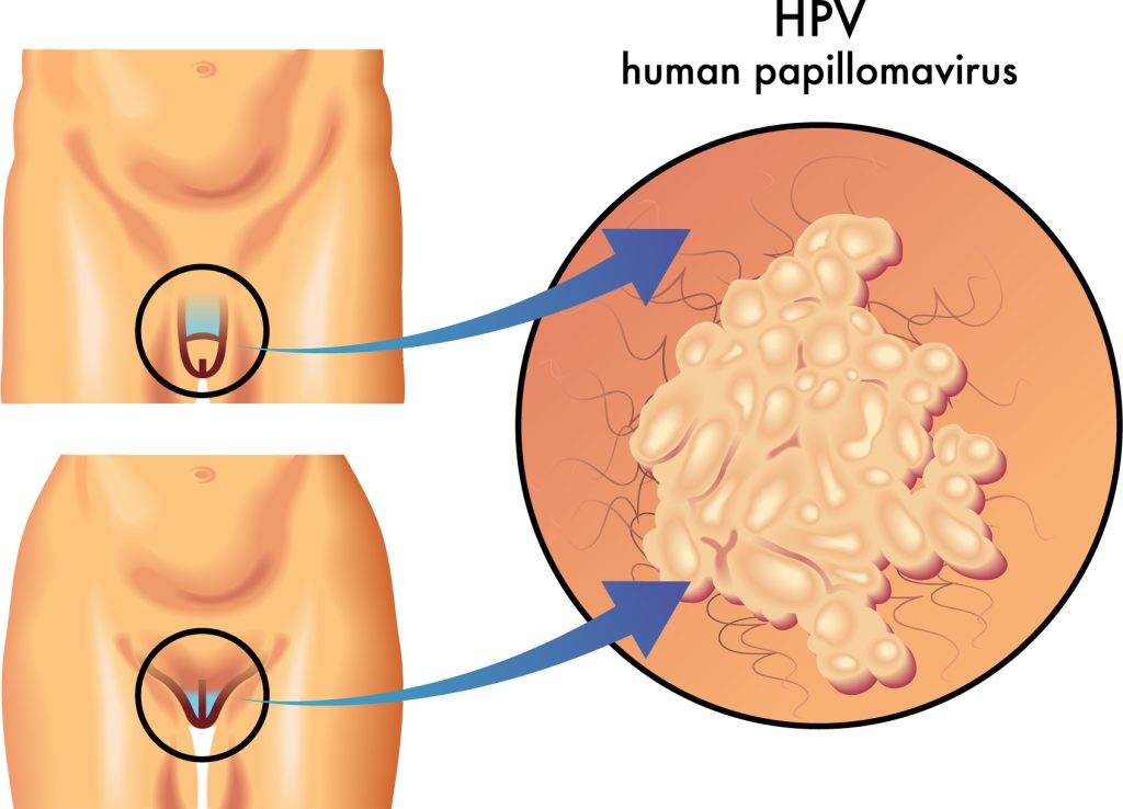 HPV Nedir