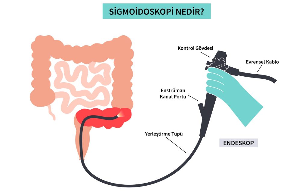 Sigmoidoskopi Nedir