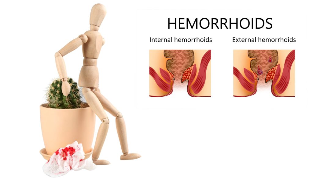 Makattan Sümüksü Akıntı Gelmesi Nedenleri Hemoroid