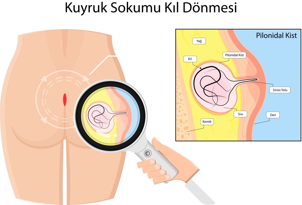 Kuyruk Sokumu Kıl Dönmesi Nedir?