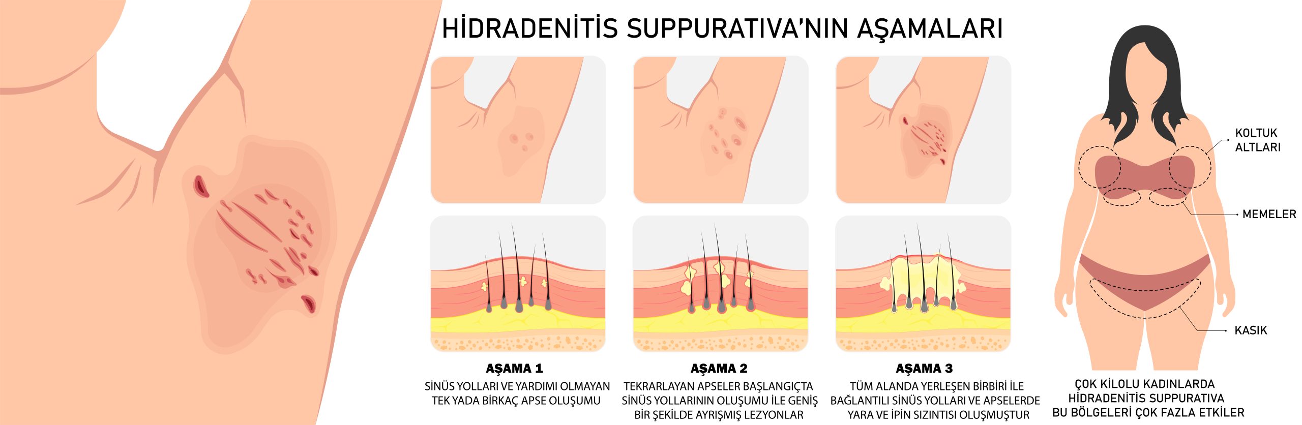 Hidradenitis Suppurativa Aşamaları
