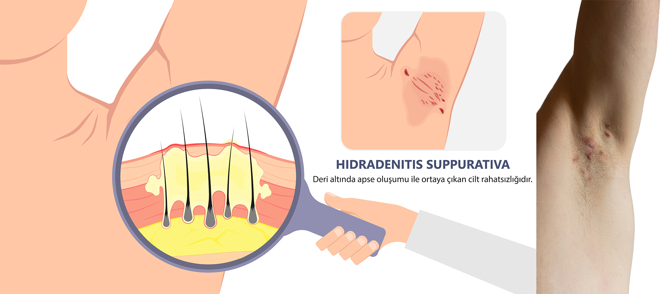 Hidradenitis Suppurativa Nedir