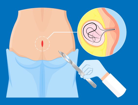 Kıl Dönmesi Tedavisi-Flep Yöntemi