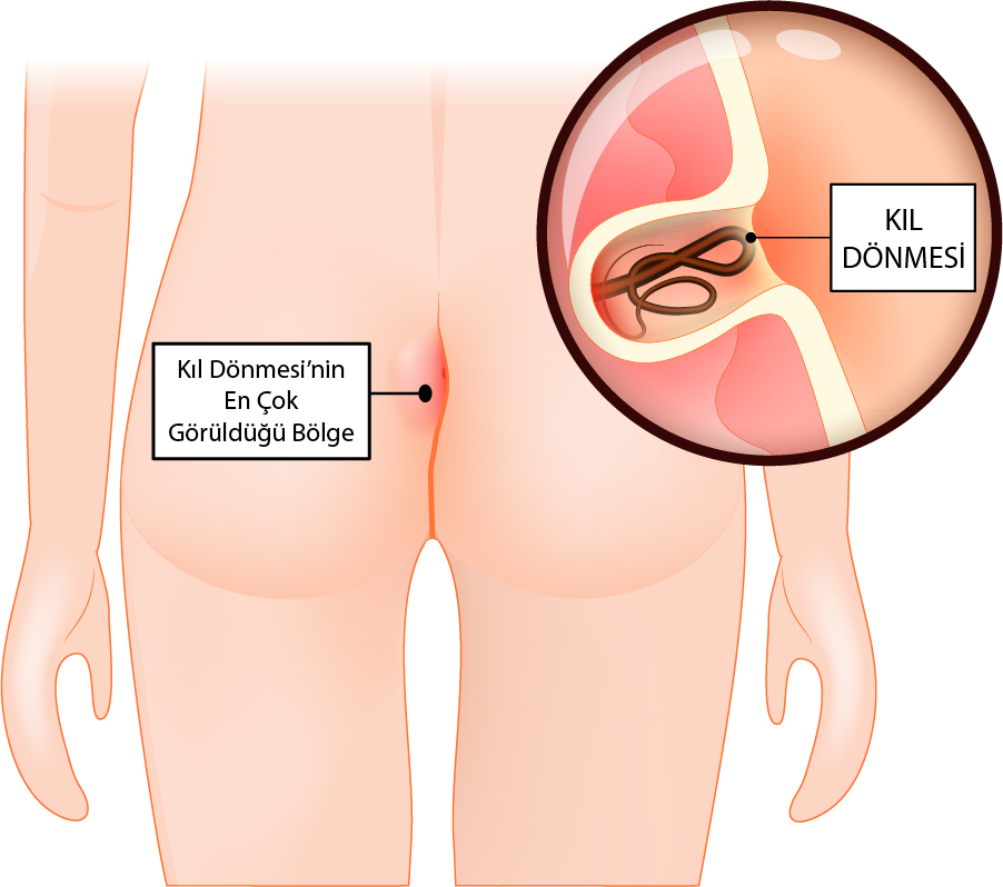 Nüks Kıl Dönmesi