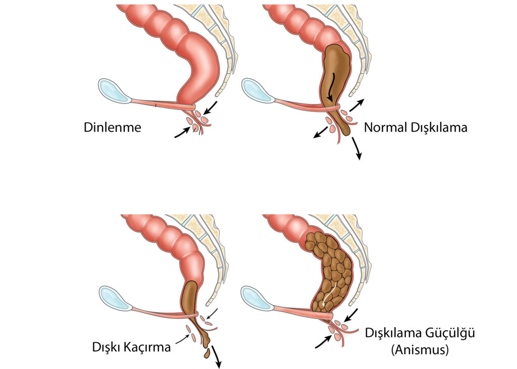 Anismus (Dışkılama Güçlüğü) Nedir