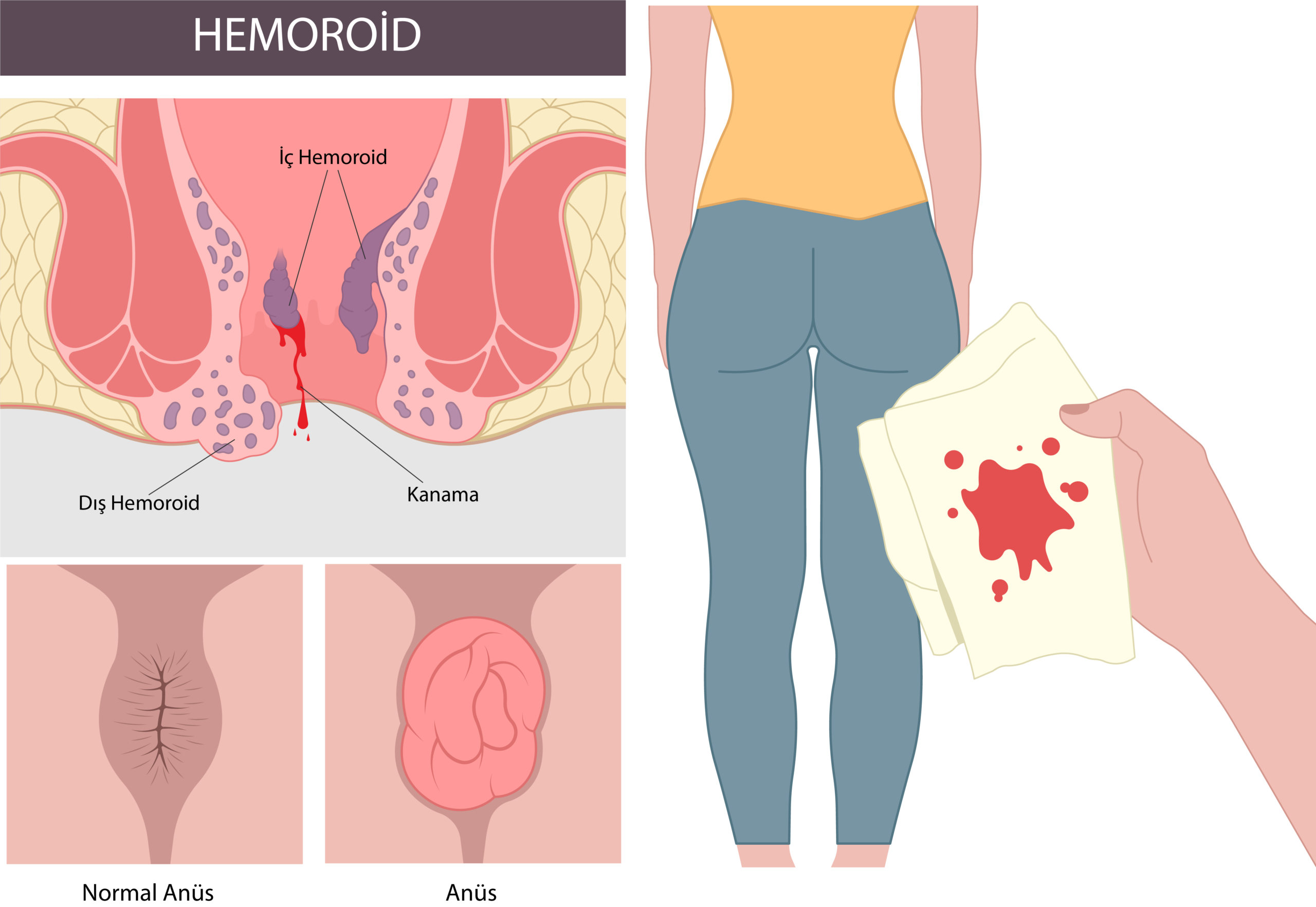 Hemoroid (Basur) (Prolabe hemoroid)
