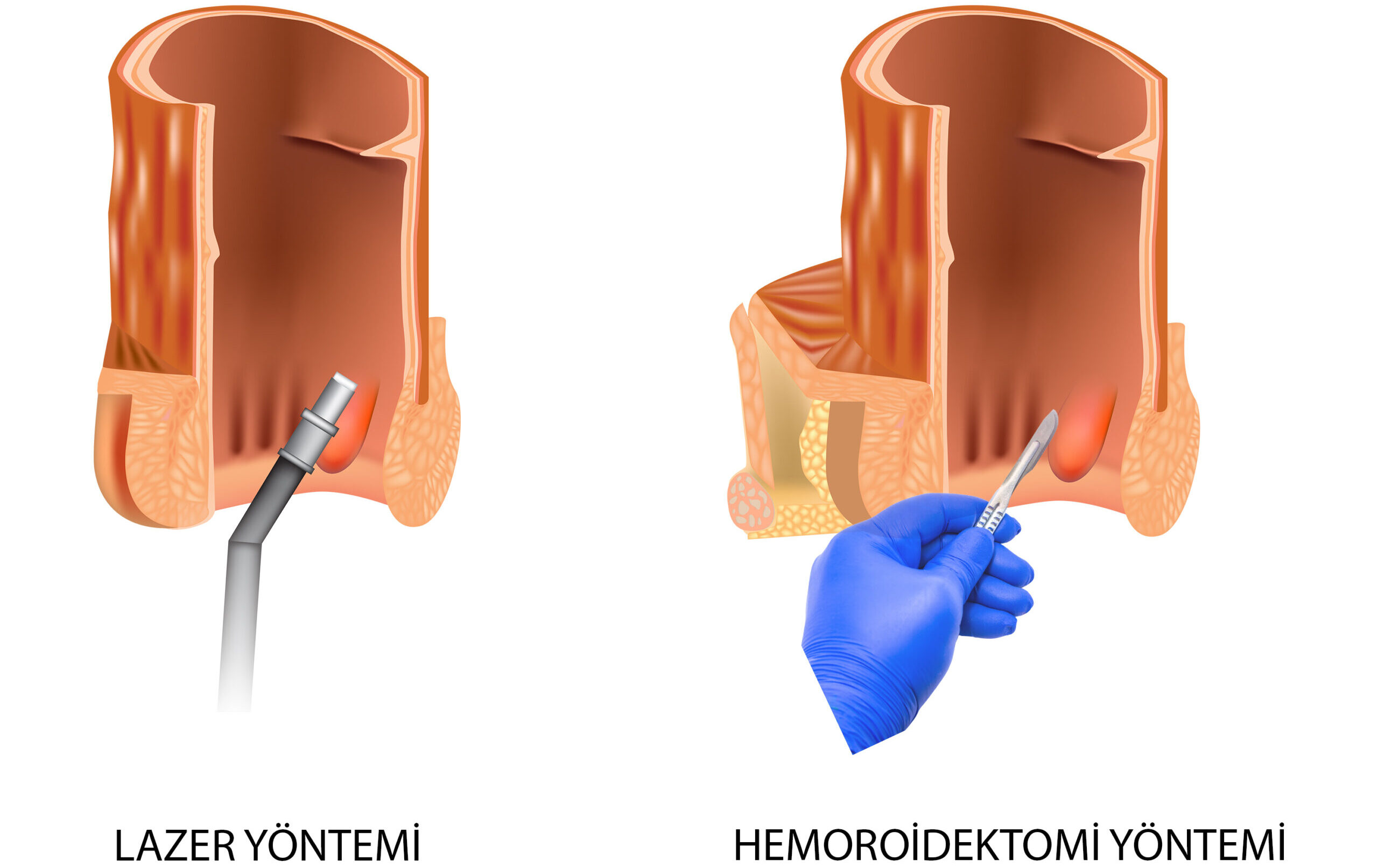 Lazerle Hemoroid Ameliyatı ve Hemoroidektomi Ameliyatı Karşılaştırması