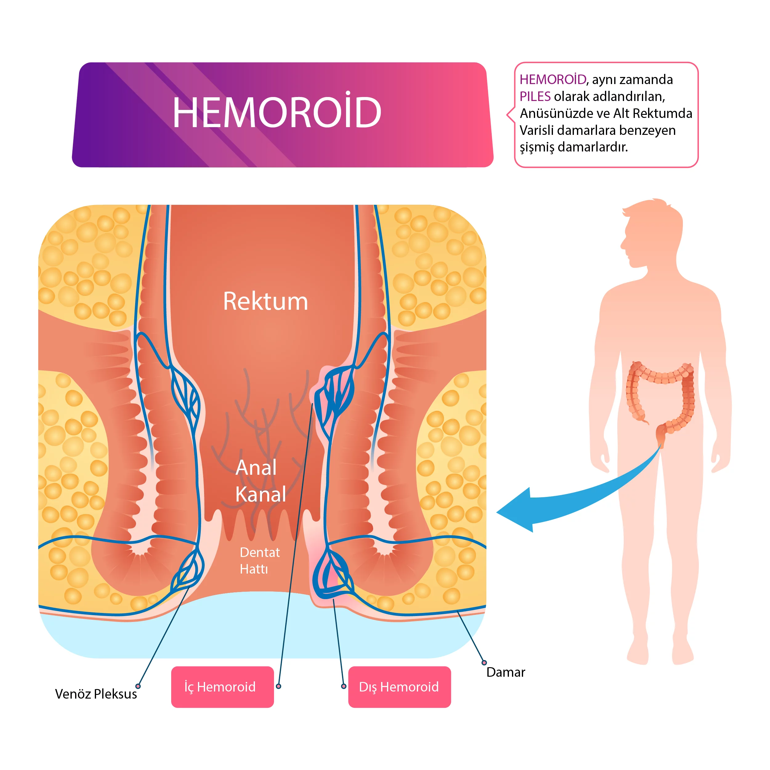 Hemoroid Ameliyatı Sonrası İyileşme Süreci Ne Kadardır