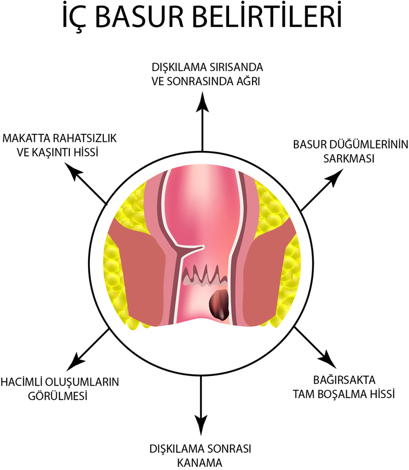 İç Hemoroid Belirtileri