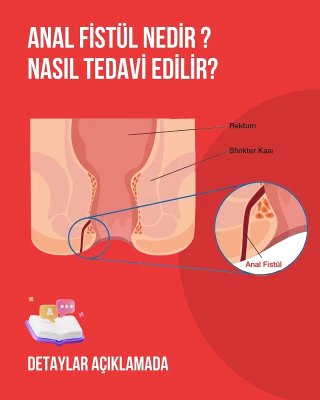 Anal Fistül Nedir? 

Kalın bağırsağın son kısmı olan anüs ile çevresindeki deri arasında sonradan oluşan tüneldir. Çoğu zaman anal apse sonrası gelişir ve tekrarlayan apseler eşlik eder. 

En Sık Görülen Bulgusu Nedir ? 

Makat çevresindeki açıklıktan ( sivilce başı gibi açıklık) kötü kokulu akıntı en tipik bulgusudur. 

Anal Fistül Tanısi Nasıl Konulur?

Çoğu zaman  proktolojik MUAYENE ile tanı koymak yeterlidir. 
Tedavi planlaması için MR ile ileri inceleme yapılması gerekebilir. 

Anal Fistül Nasıl Tedavi Edilir ?

Anal fistül tedavisi CERRAHİ (fistülotomi, lazer, seton, VAFT gibi) yöntemler ile yapılmaktadır, ilaçla tedavisi yoktur. 

Tedavinin amacı 
1- Fistülü iyileştirmek 
2- Nüks gelişimini engellemek 
3- Makat fonksiyonlarını (gaz ve dişkl) korumak

Cerrahi tedavisi perianal fistül hastalığında deneyim kazanmış proktologlar tarafından gerçekleştirilir

#fistül
#fistula
#analfistül
#perianalfistül
#analfistula
#perianalfistula
#analfistültedavisi
#fistültedavisi
#fistultedavisi
#fistülameliyatı
#anal
#ibd