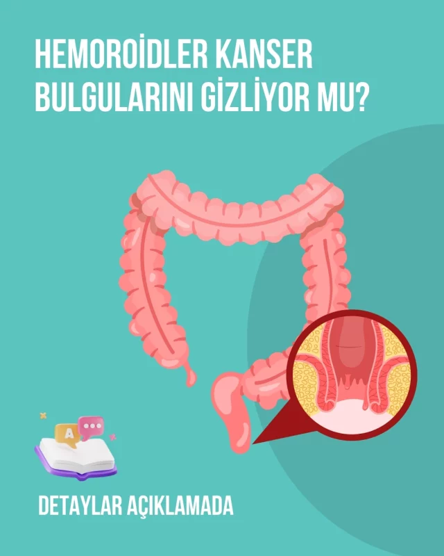 Makattan kan gelmesi hem hemoroidin hem de bağırsak kanserinin belirtilerindendir. Bu yüzden hemoroid ve bağırsak kanseri hastalar tarafından birbiriyle karıştırılabilir. Bağırsak kanseri, makat kanseri ve hemoroid aynı bölgeden kaynaklanan hastalıklardır ve belirtileri benzerdir.

Hemoroidler ve Hemoroid kanaması kansere neden olmaz.

Hemoroid tanısı almış fakat tedavi edilmemiş bir hasta; makat kanamasının nedenini hemoroid kaynaklı olduğunu düşüp bu durumu görmezden gelebilir.

Kolon kanseri ve hemoroid belirtilerinin karıştırılması, doğru teşhisi geciktirebilir. Erken tanı ve doğru tedavi süreçleri için uzman desteği almak hayati önemdedir.

#hemoroid
#basur
#hemoroidhastalığı
#hemorrhoids
#hemorrhoidssuck
#Hämorrhoiden
#hämorrhoidenheilen
#basurtedavisi
#hemoroidtedavisi
#hemoroidsizhayat
#hemoroidalhastalıklar
#hemoroidalhastalık
#kanser
#kanserdeğilbizgüçlüyüz
#kanserbulgusu
#cancerawareness 
#cancerfighter 
#krebs 
#cancer